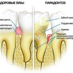  Boala parodontală